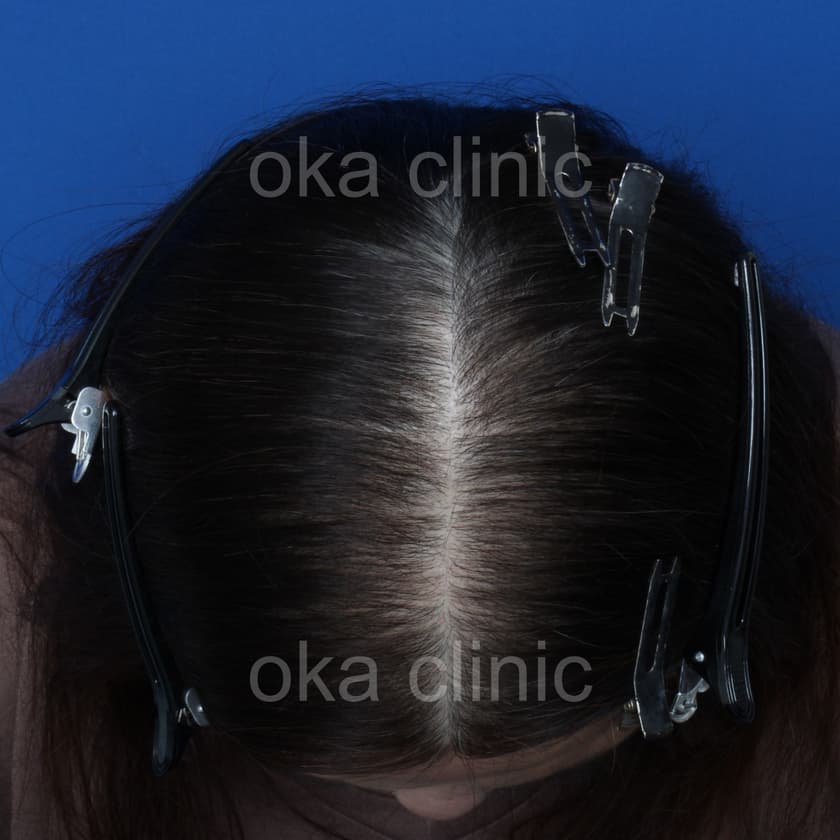 頭頂　サイドの治療後の画像