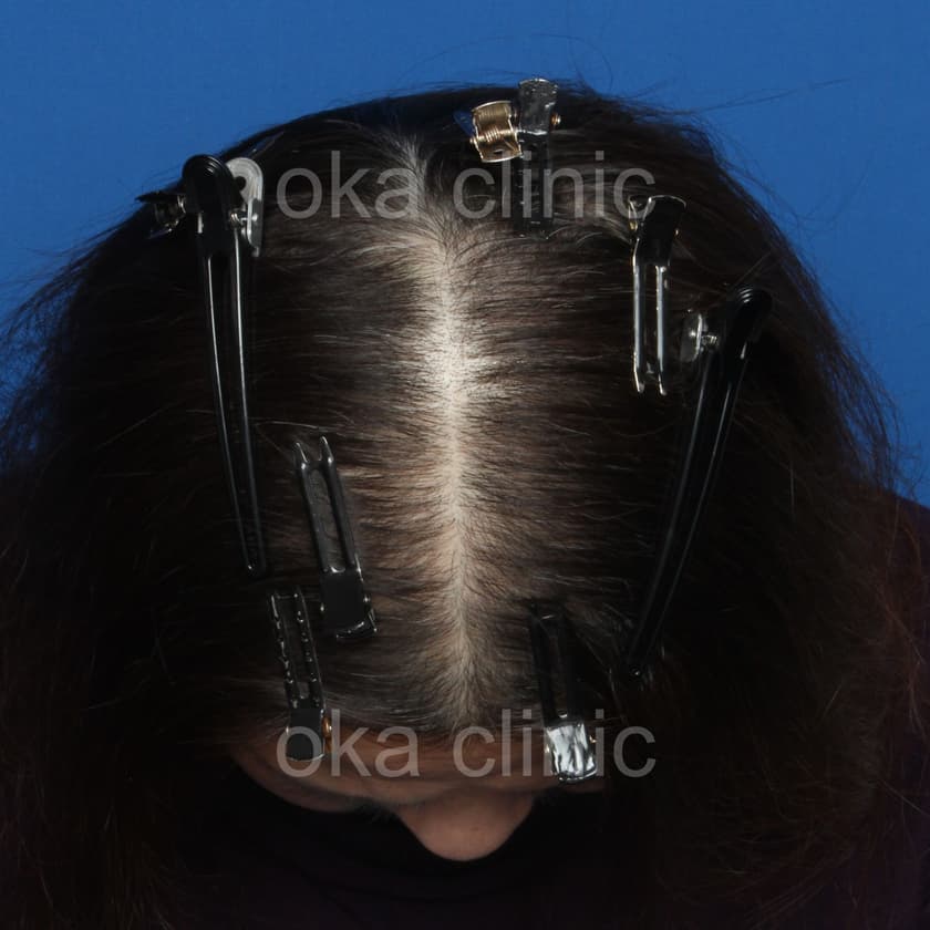 頭頂　サイドの治療前の画像