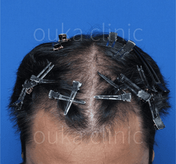 23歳男性 治療前