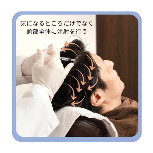 H-non療法では頭皮全体に注射を行う