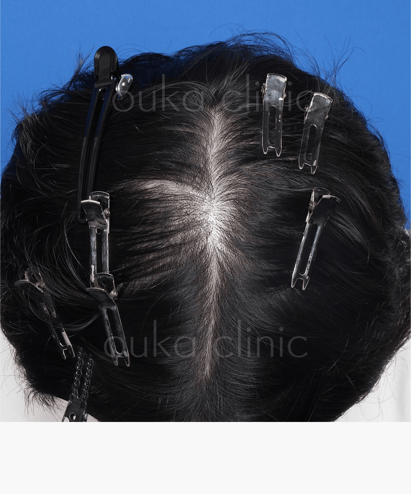 頭頂の治療後の画像