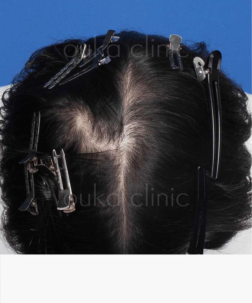 頭頂の治療前の画像