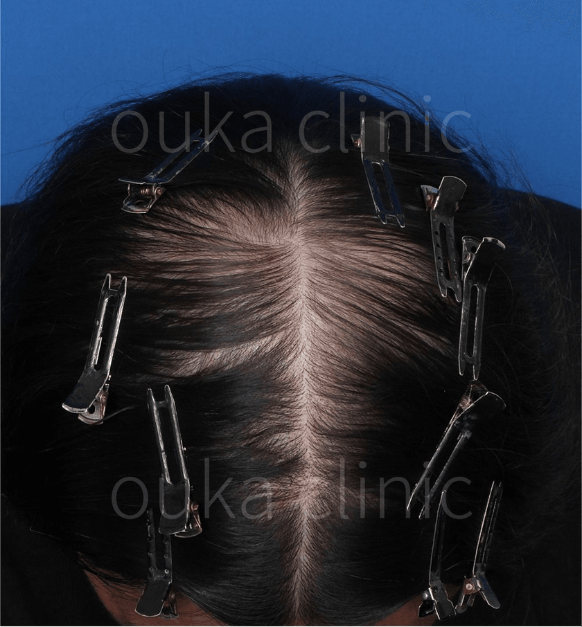 頭頂の治療後の画像