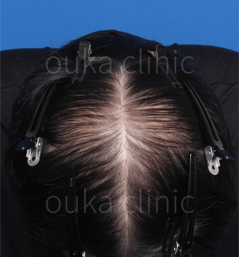 頭頂の治療前の画像