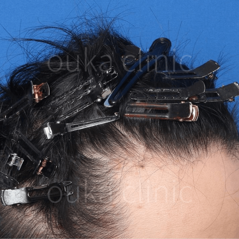 生え際の治療前の画像