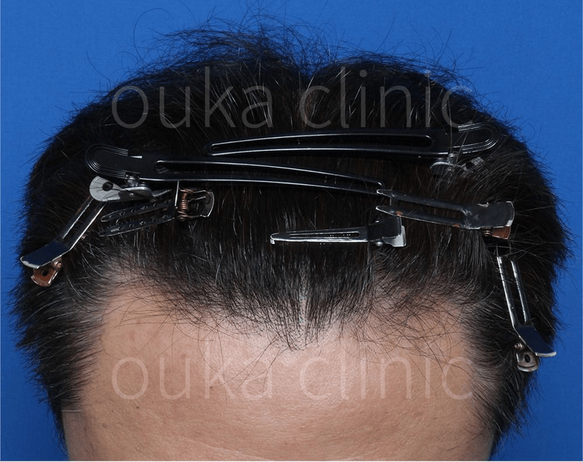 頭頂　生え際の治療後の画像