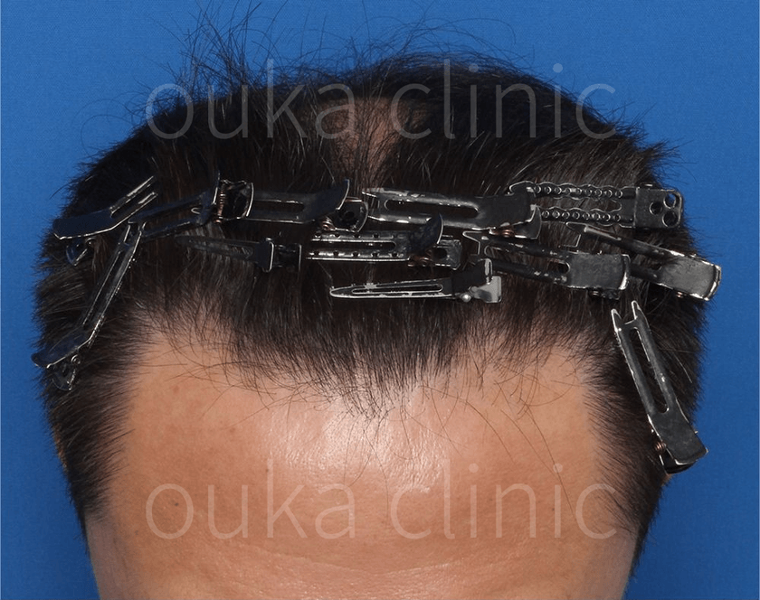 頭頂　生え際の治療前の画像