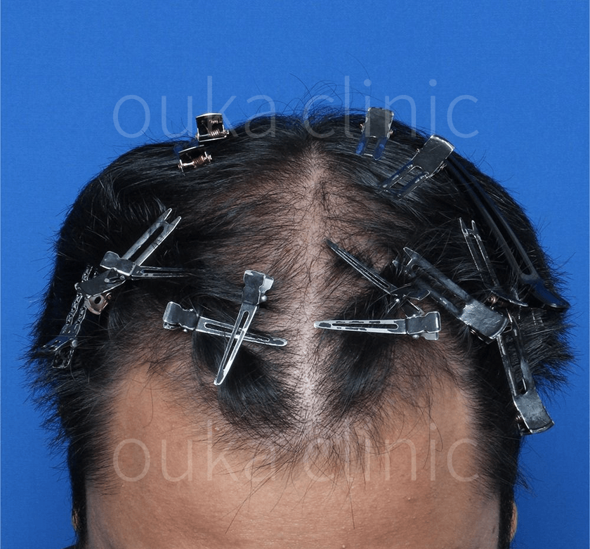 はえ際　頭頂の治療前の画像