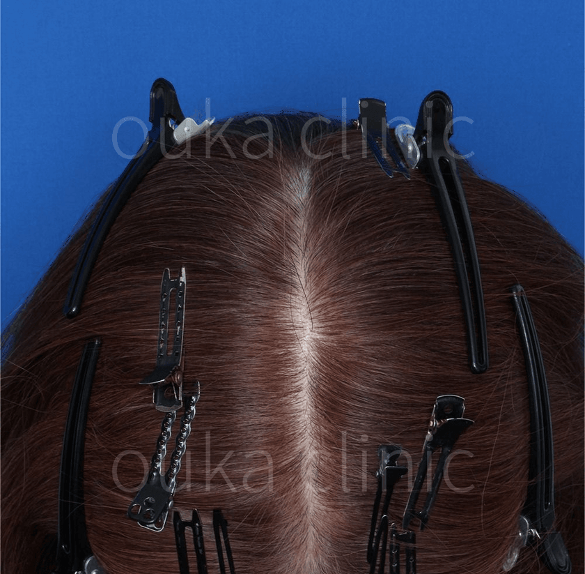 生え際、全体の治療後の画像