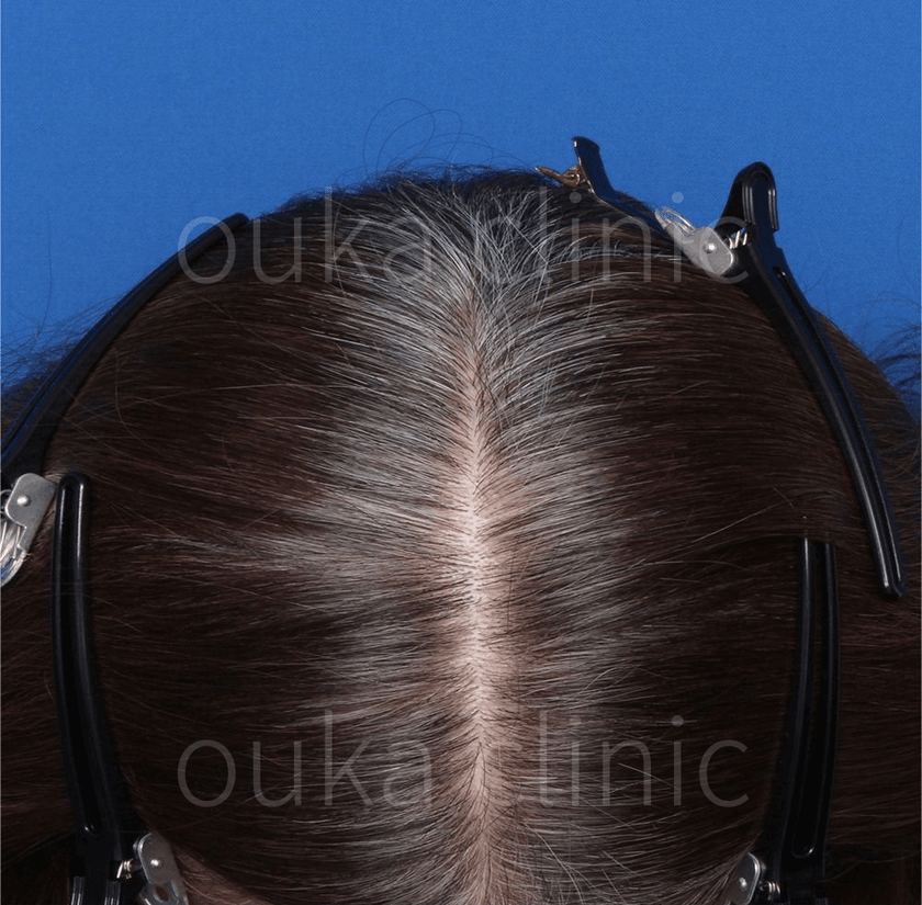 生え際、全体の治療前の画像