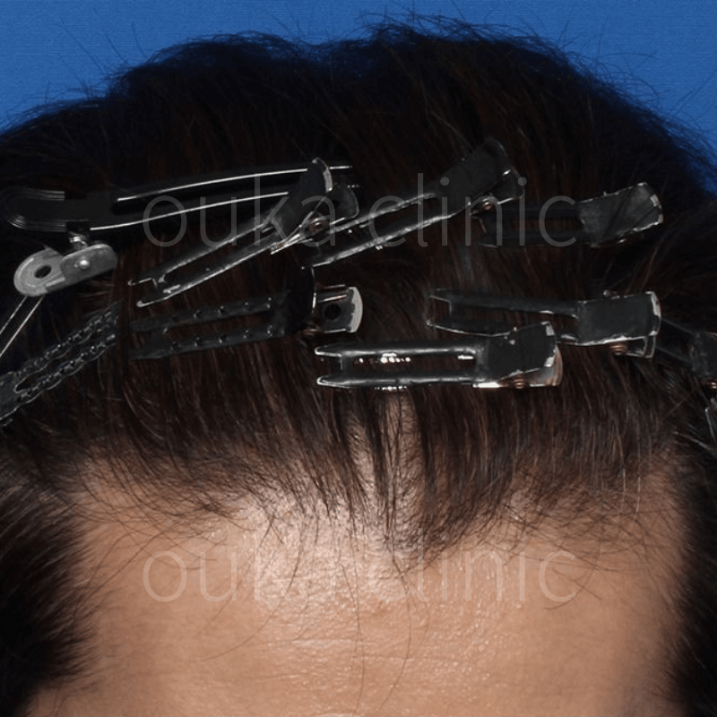 M字　頭頂の治療後の画像