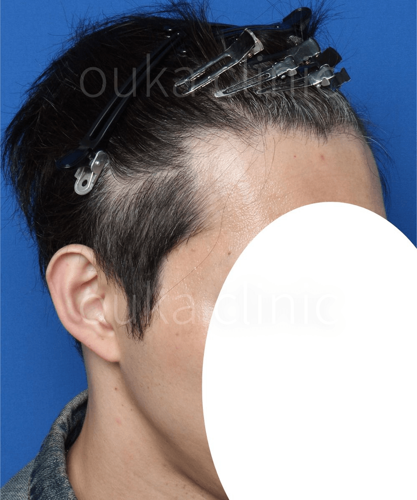 M字　頭頂の治療前の画像