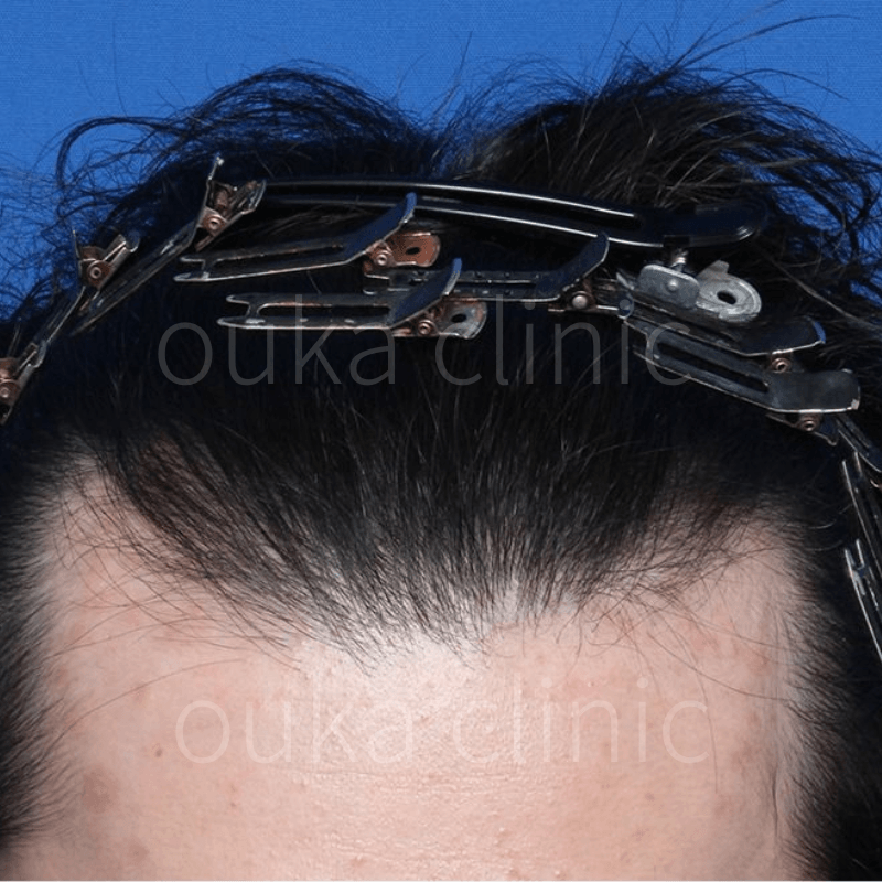 頭頂部、M字の治療後の画像