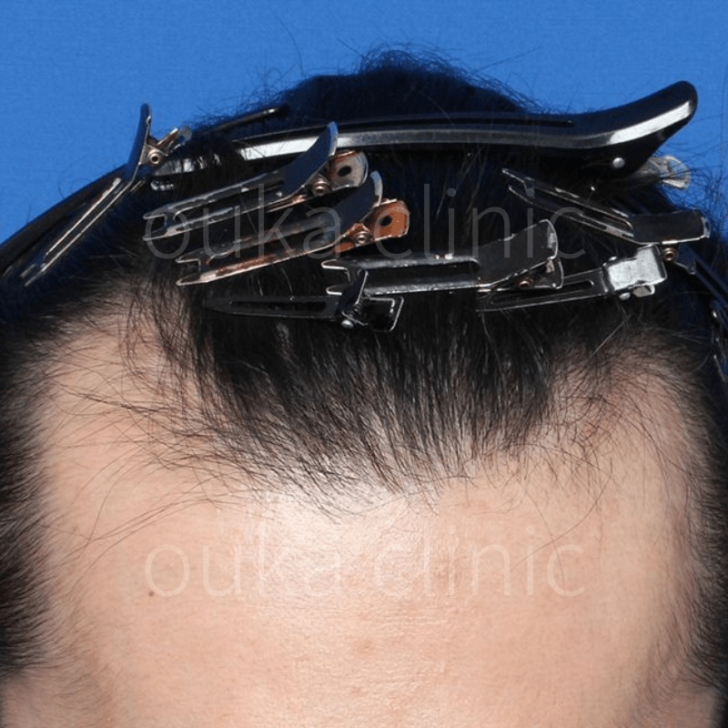 頭頂部、M字の治療前の画像