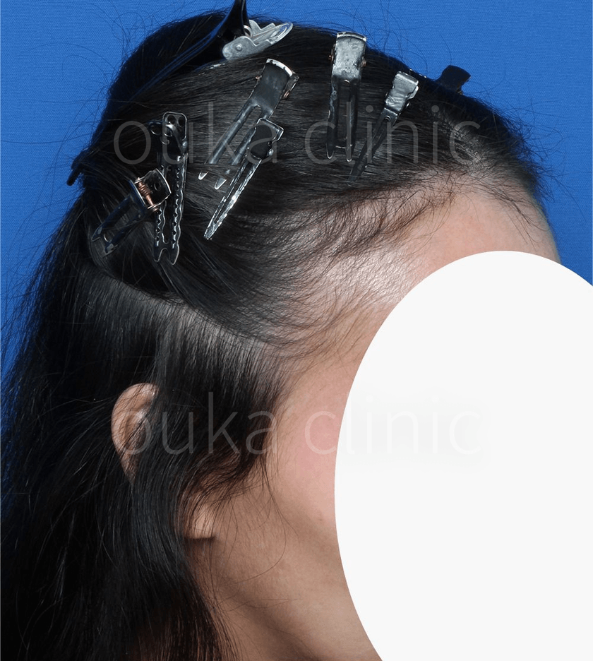 生え際、分け目の治療後の画像