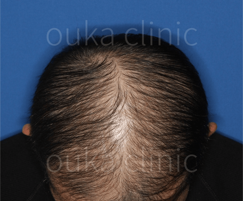生え際　頭頂の治療後の画像