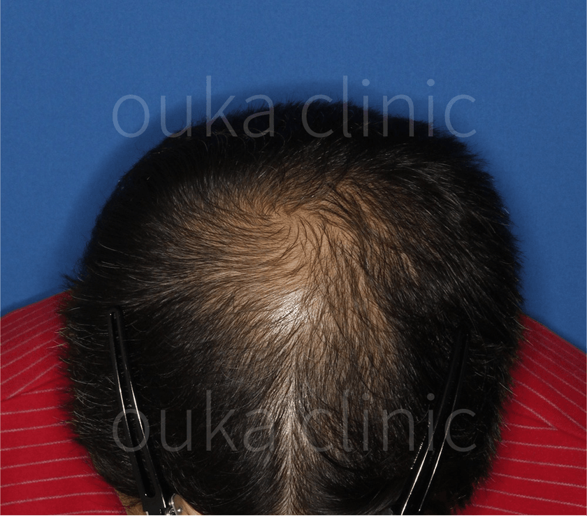 頭頂の治療後の画像