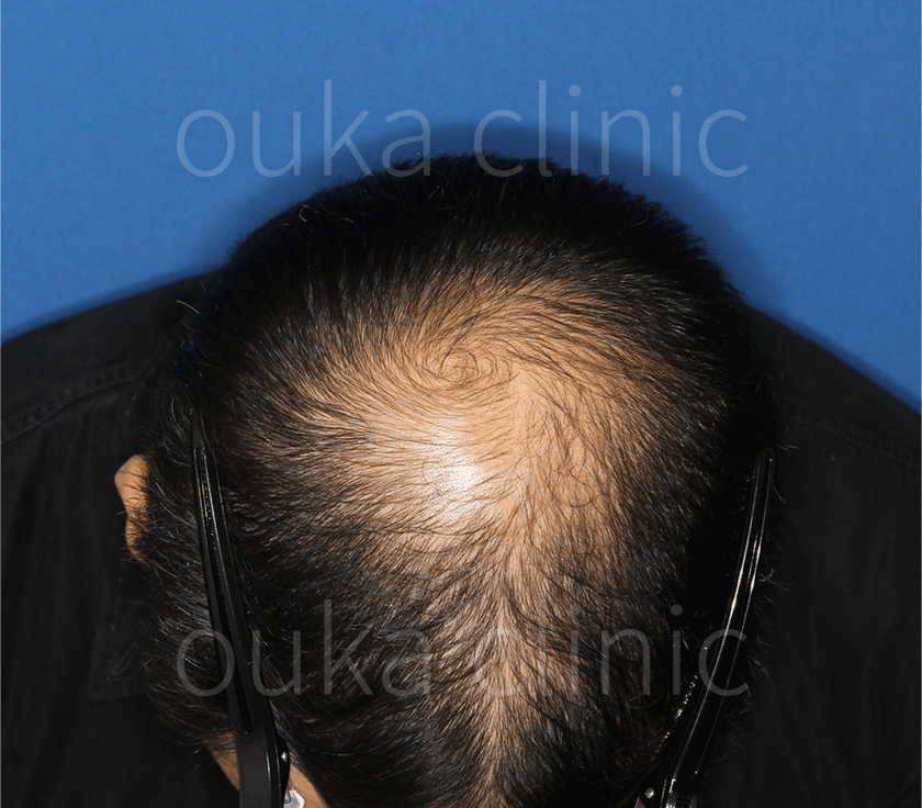 頭頂の治療前の画像