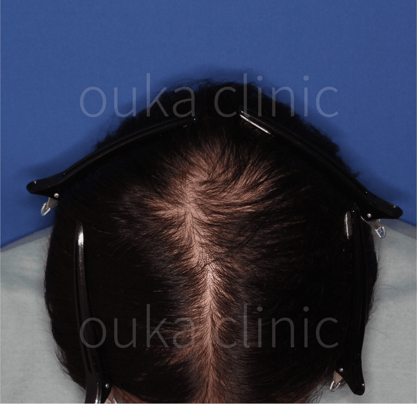 頭頂　生え際　分け目の治療前の画像