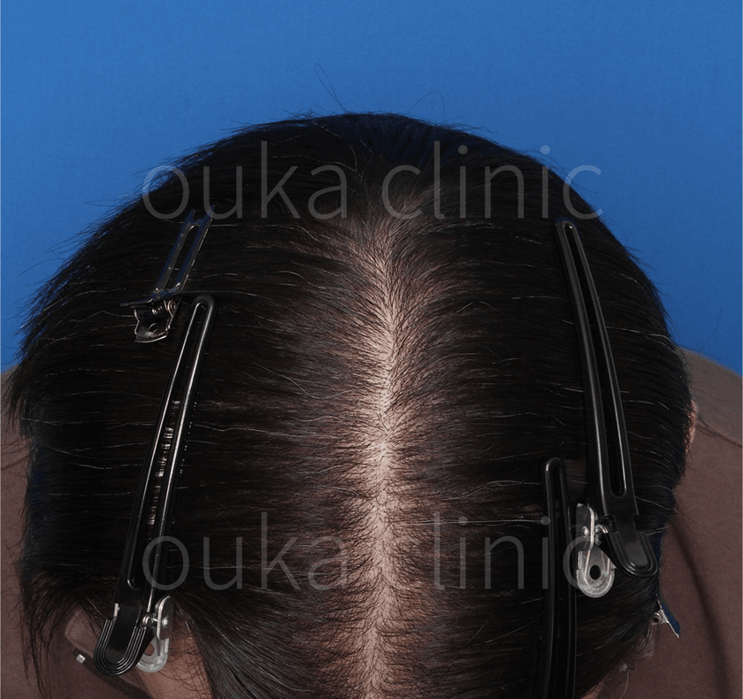 頭頂　生え際　分け目の治療後の画像