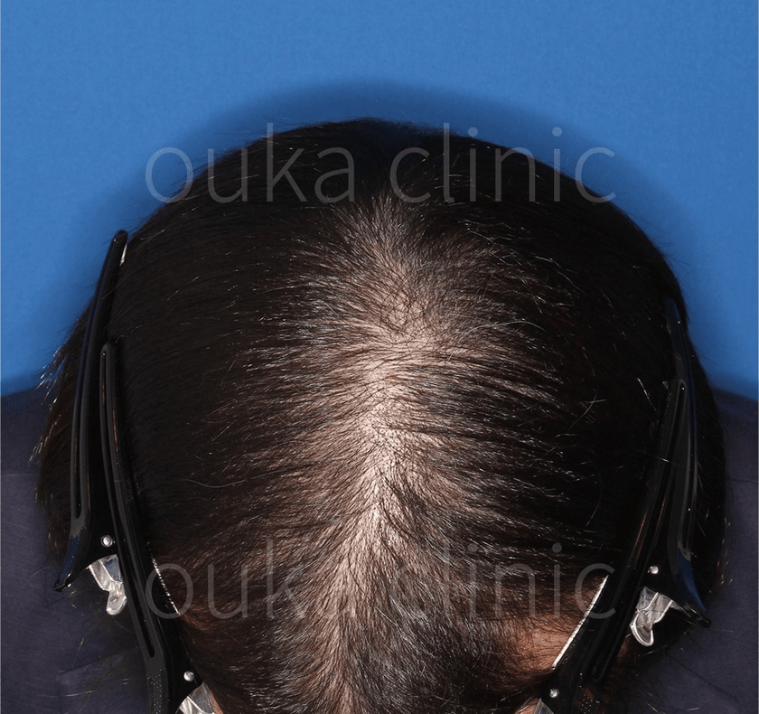 頭頂　生え際　分け目の治療前の画像
