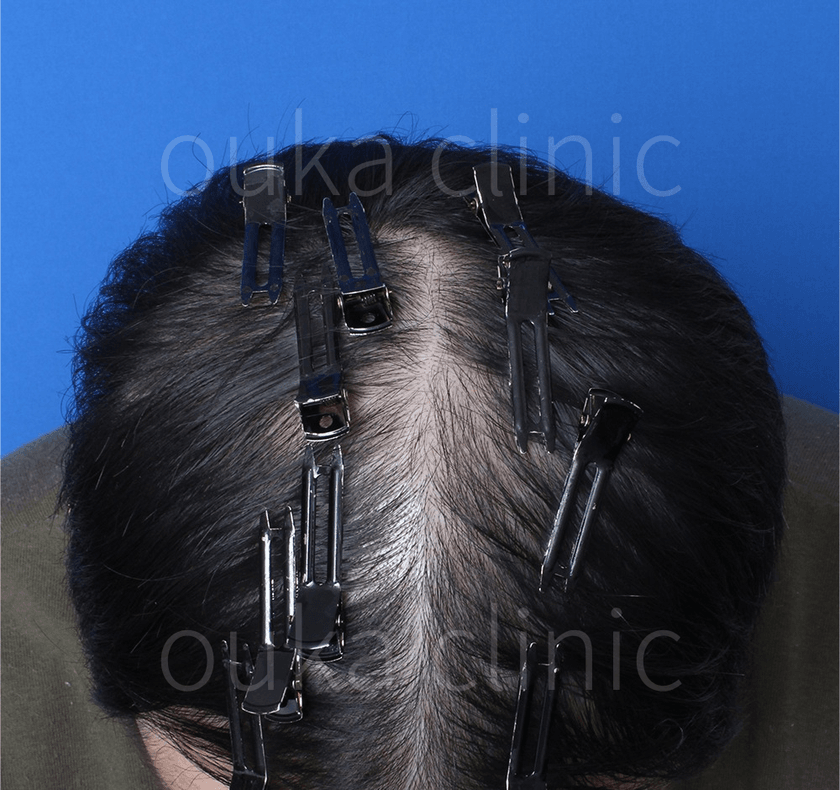 全体の治療後の画像