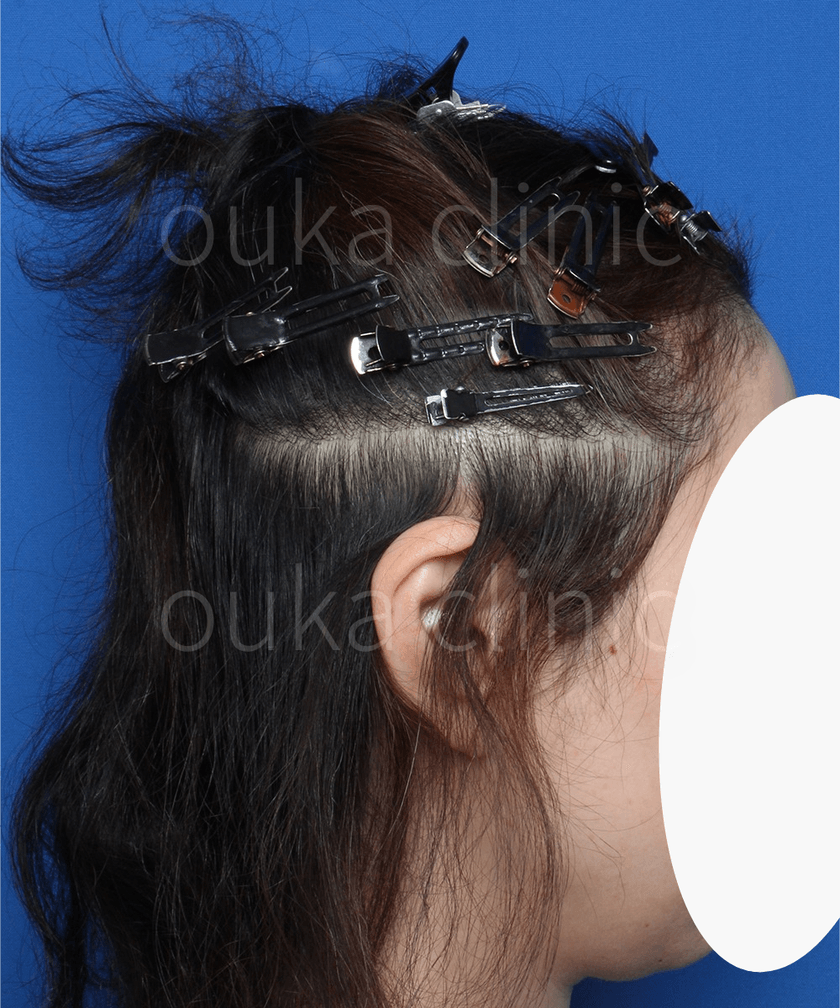 生え際の治療後の画像