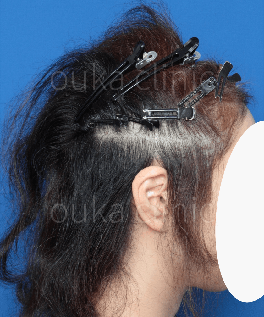 生え際の治療前の画像