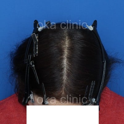 全体 サイドの治療後の画像