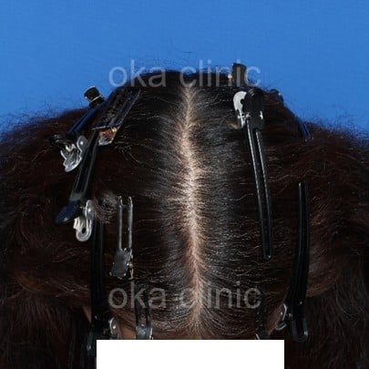 全体 サイドの治療前の画像