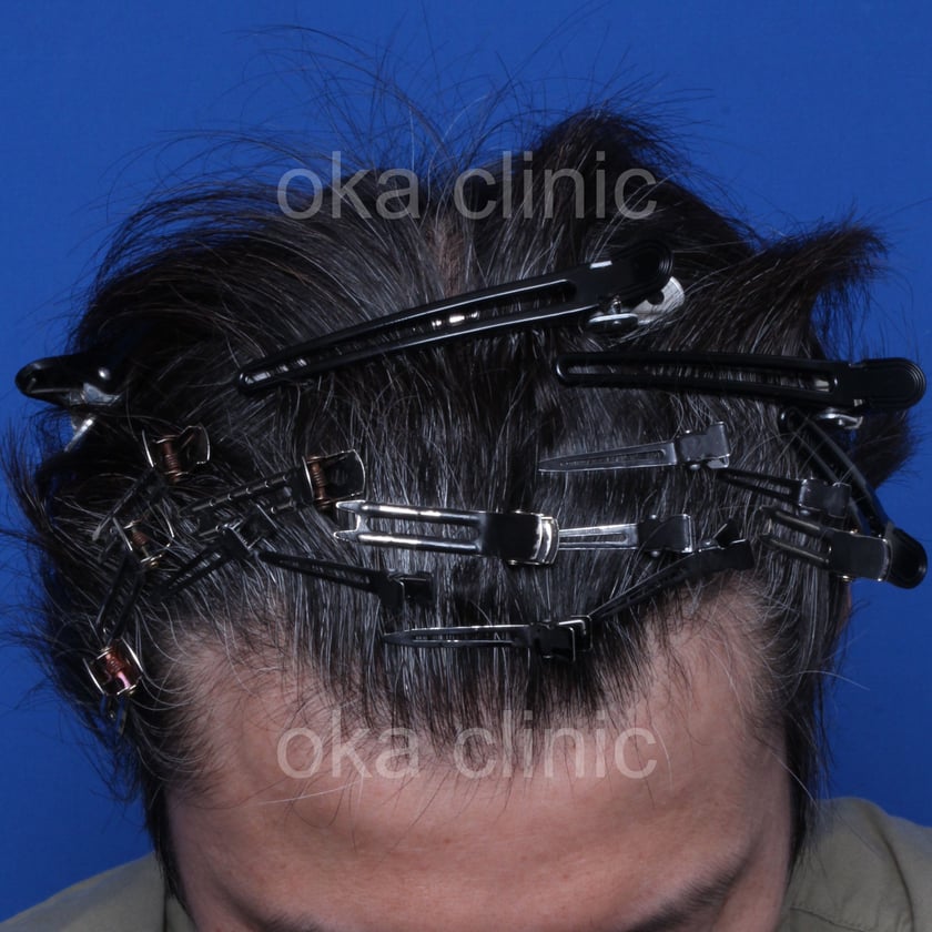 頭頂の治療後の画像