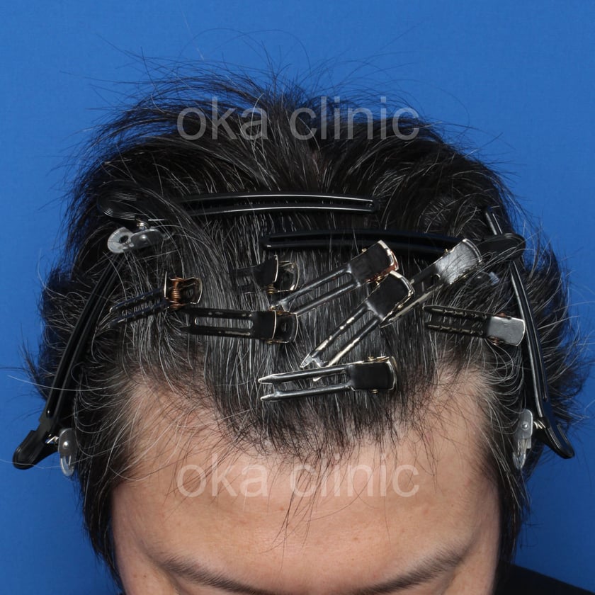 頭頂の治療前の画像