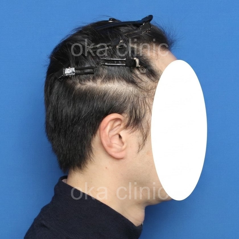 頭頂、つむじの治療後の画像