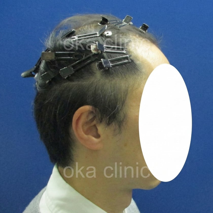 頭頂、つむじの治療前の画像