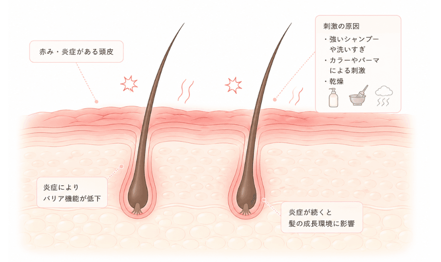 頭皮の赤み・炎症が起きている状態を示したイラスト