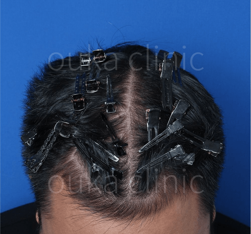 23歳男性 治療後