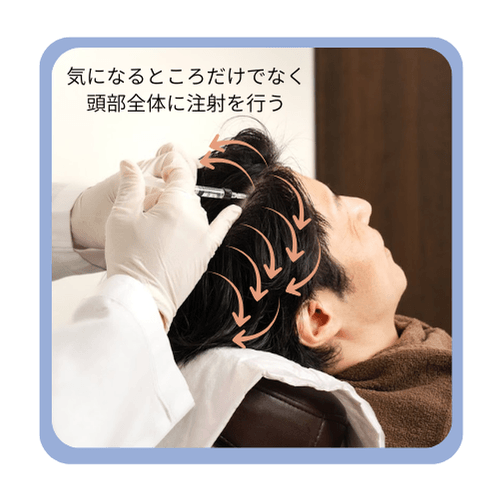 H-non療法では頭皮全体に注射を行う