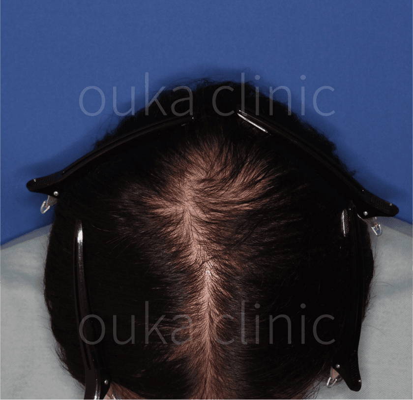 頭頂 生え際 分け目の治療前の画像