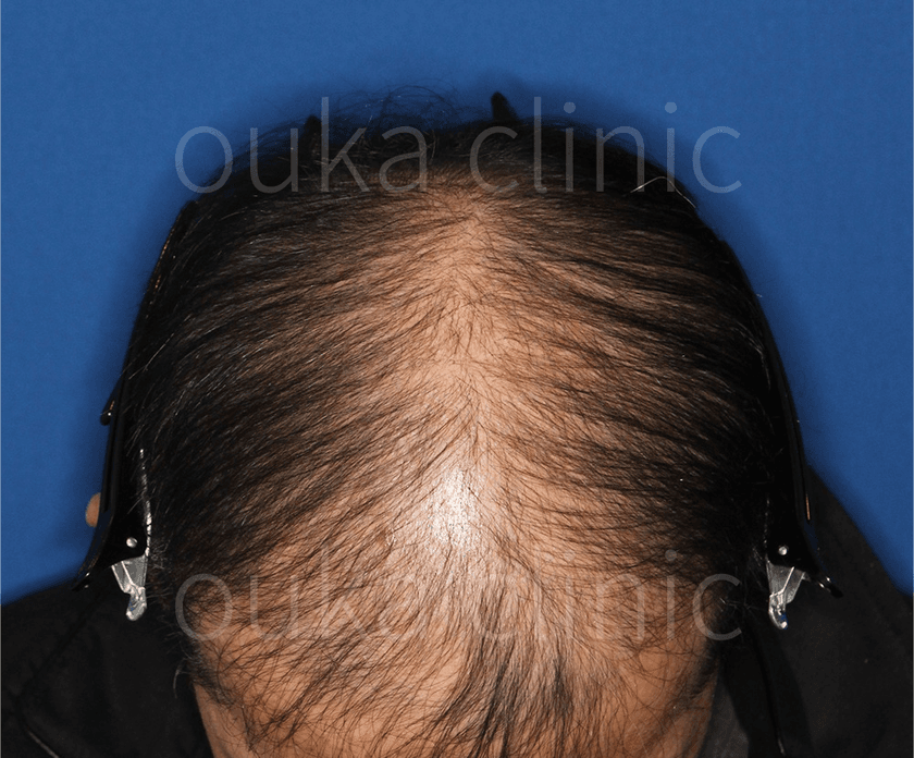 生え際 頭頂の治療前の画像