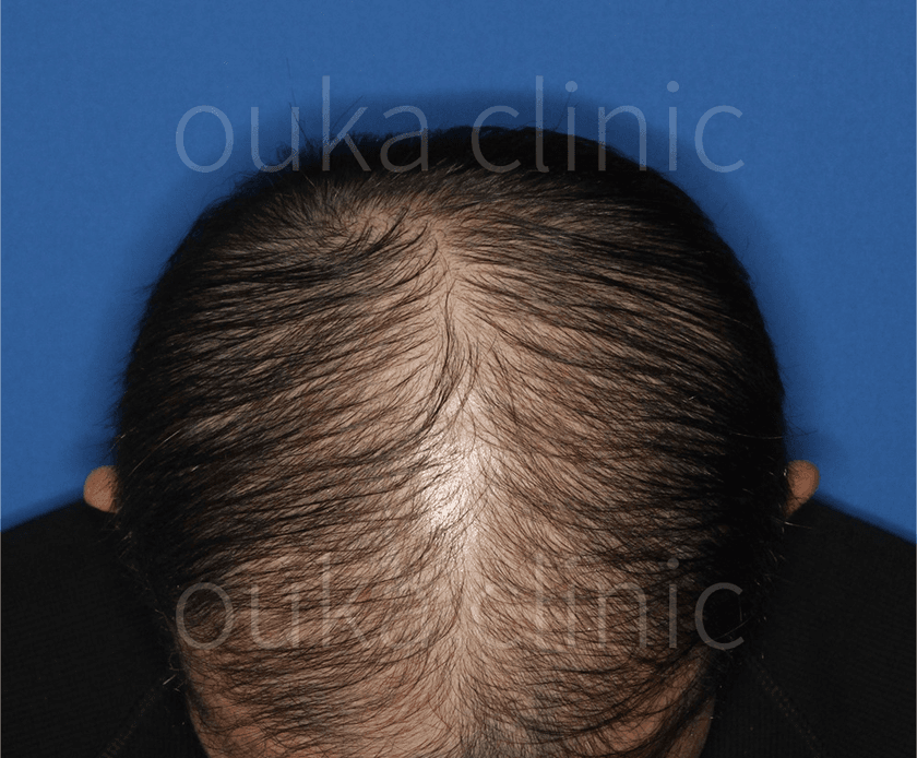 生え際 頭頂の治療後の画像