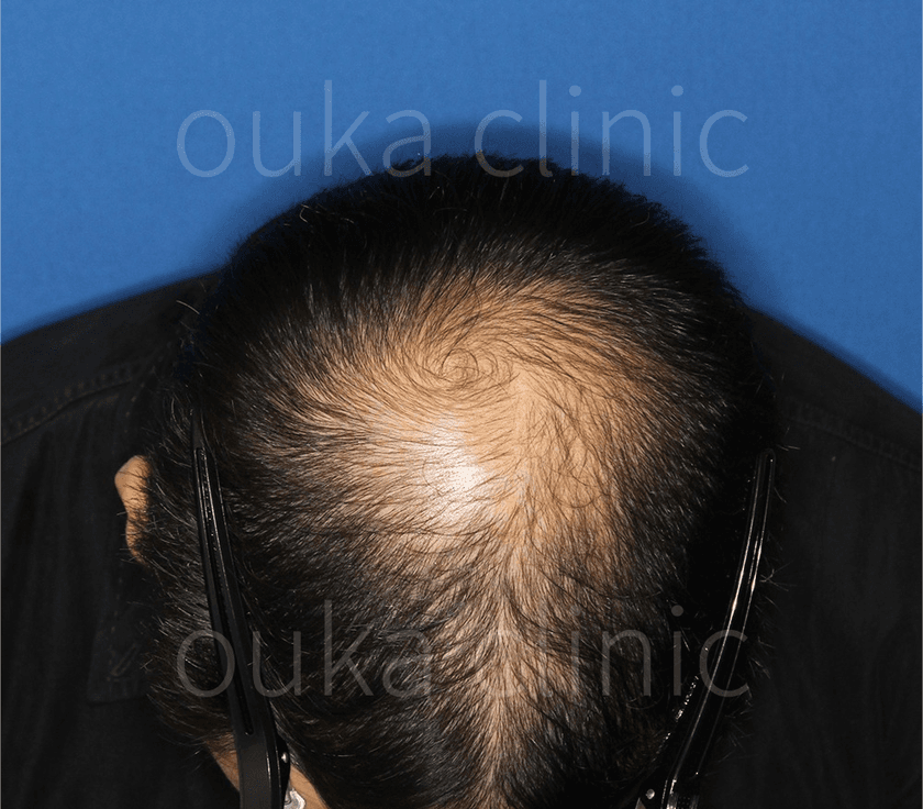 頭頂の治療前の画像