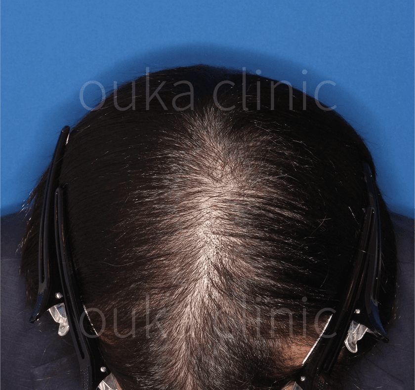 頭頂 生え際 分け目の治療前の画像