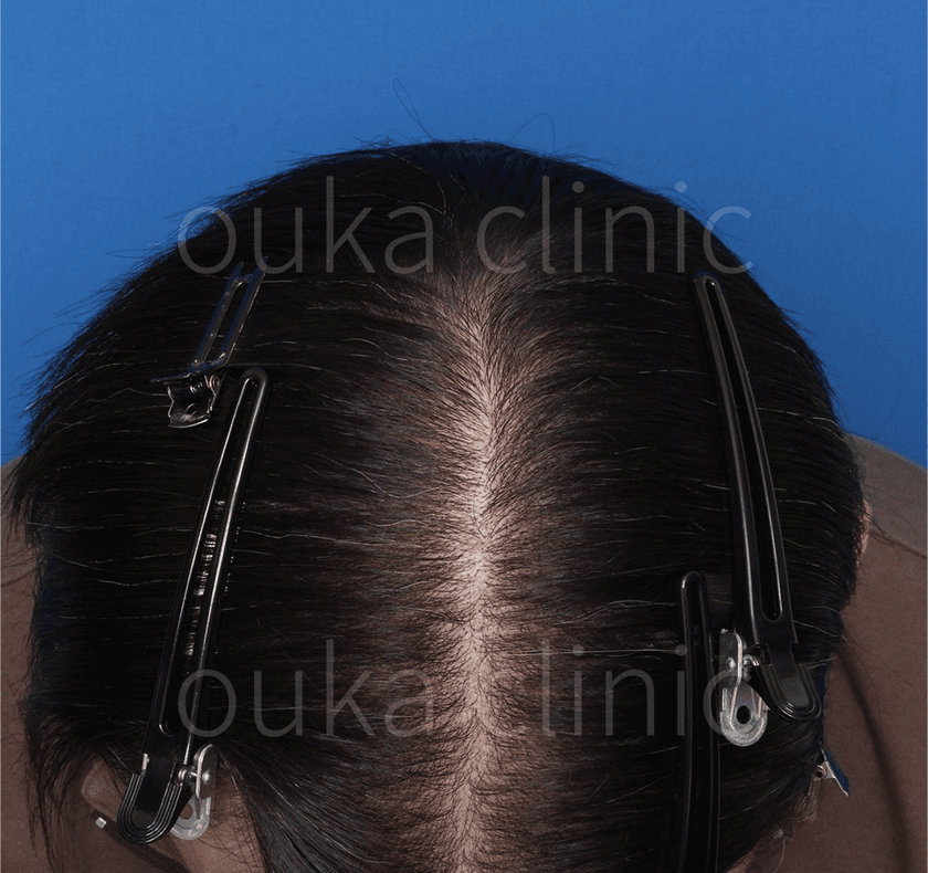 頭頂 生え際 分け目の治療後の画像