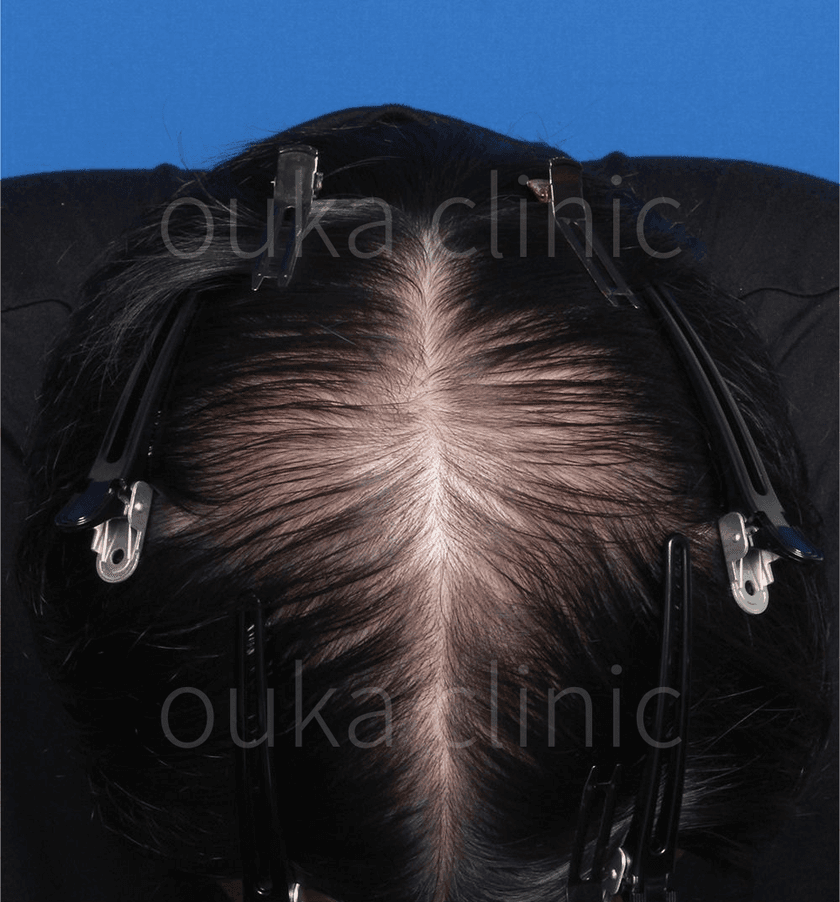 頭頂の治療前の画像