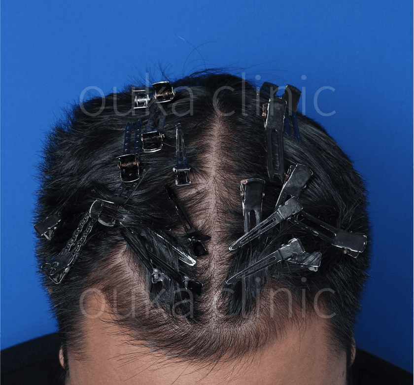 はえ際 頭頂の治療後の画像