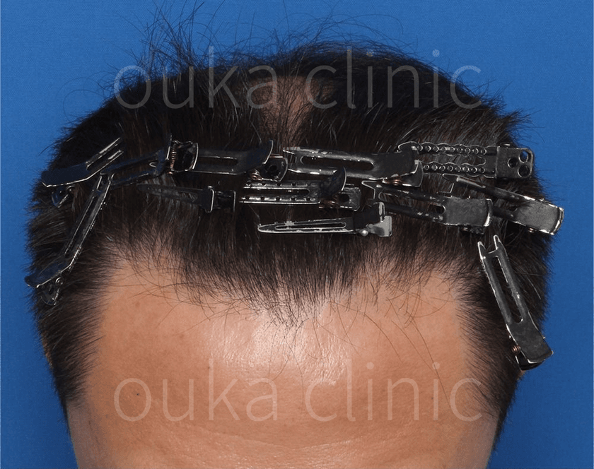 頭頂 生え際の治療前の画像