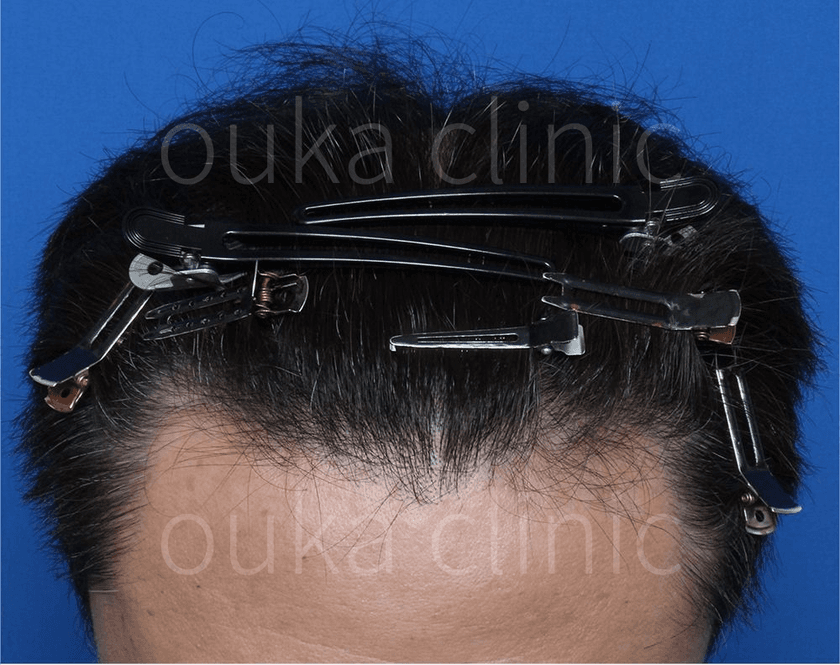 頭頂 生え際の治療後の画像