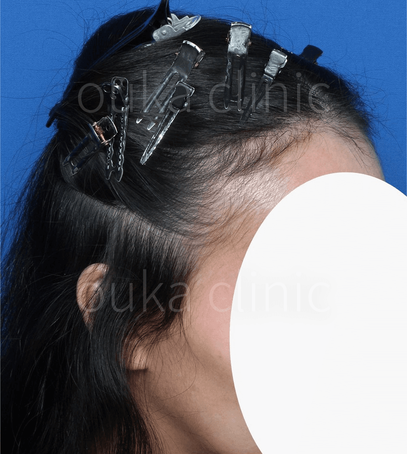 生え際、分け目の治療後の画像